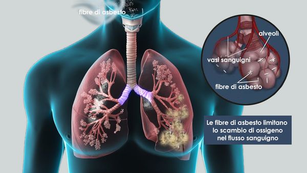 Documento dell' Associazione Italiana di Epidemiologia sulle malattie asbesto correlate